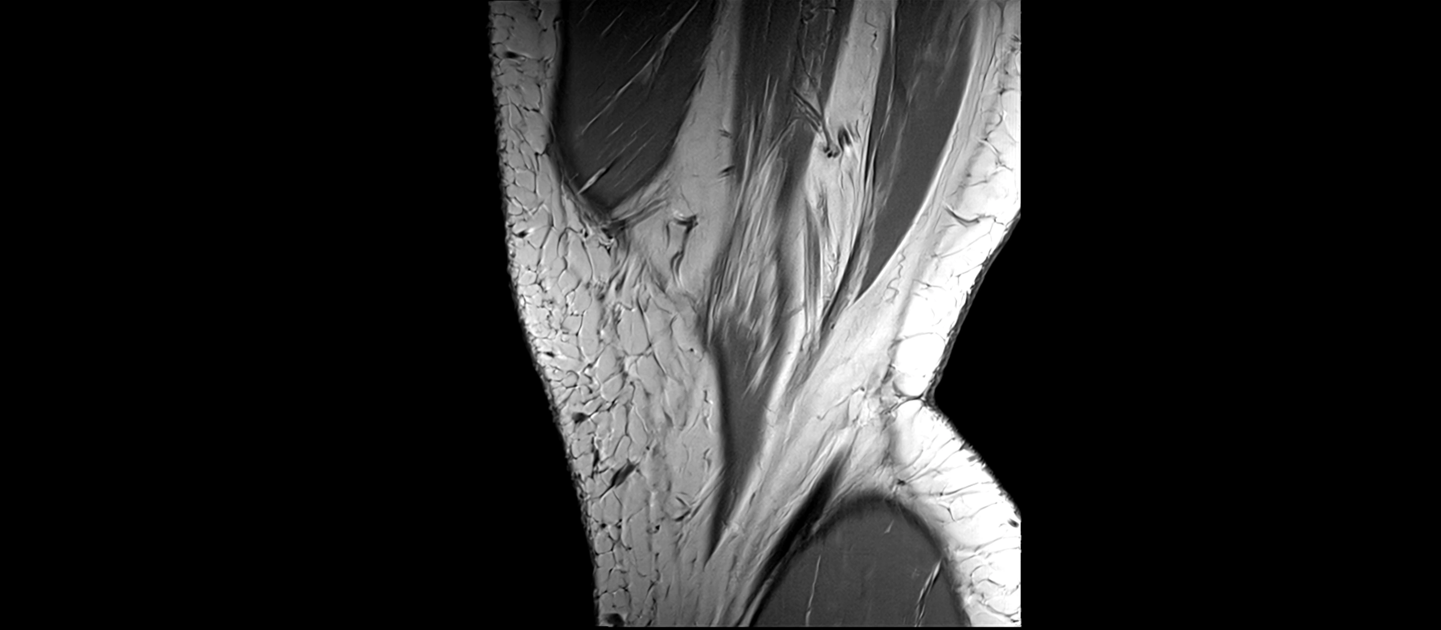 MRI sagittal  ligaments cross sectional anatomy 3T  radiology  image-img-00001-00005.webp